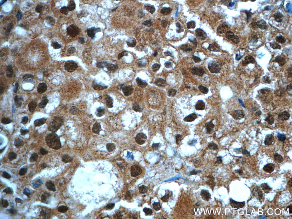 Immunohistochemistry (IHC) staining of human breast cancer tissue using WDR61 Polyclonal antibody (22536-1-AP)