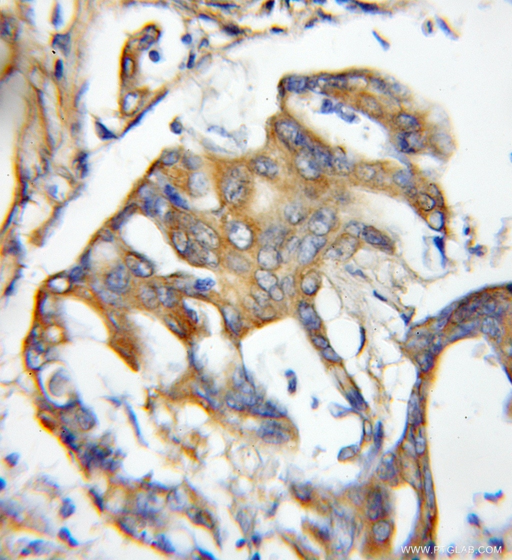 Immunohistochemistry (IHC) staining of human colon cancer tissue using WDR68 Polyclonal antibody (11683-1-AP)