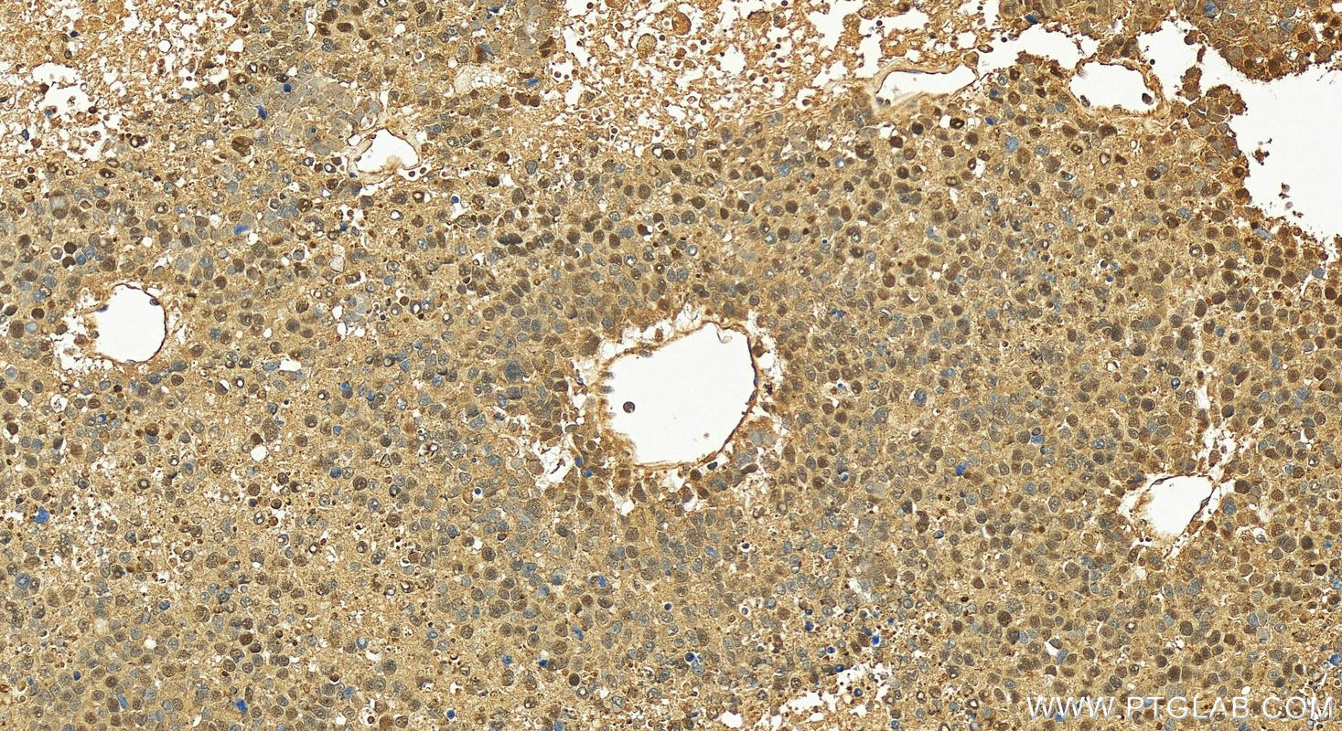 Immunohistochemical analysis of paraffin-embedded human hepatocellular carcinoma slide using 20631-1-AP (WDR74 antibody) at dilution of 1:200 (under 20x lens). Heat mediated antigen retrieval with Tris-EDTA buffer (pH 9.0). Immunohistochemistry (IHC) staining of human hepatocellular carcinoma using WDR74 Polyclonal antibody (20631-1-AP)