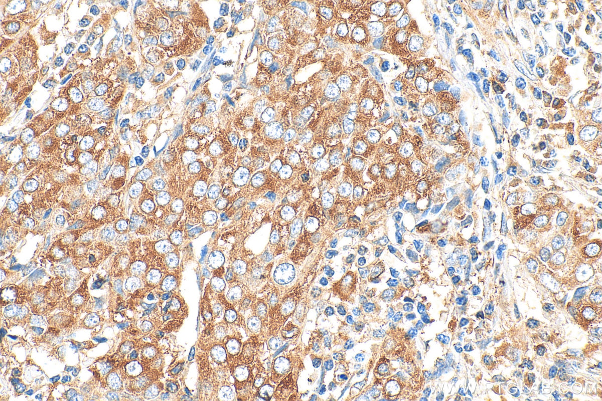 Immunohistochemistry (IHC) staining of human ovary tumor tissue using WDSOF1 Polyclonal antibody (33483-1-AP)