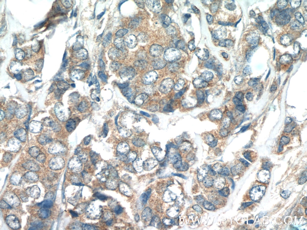 Immunohistochemistry (IHC) staining of human breast cancer tissue using WFDC1 Polyclonal antibody (13204-1-AP)