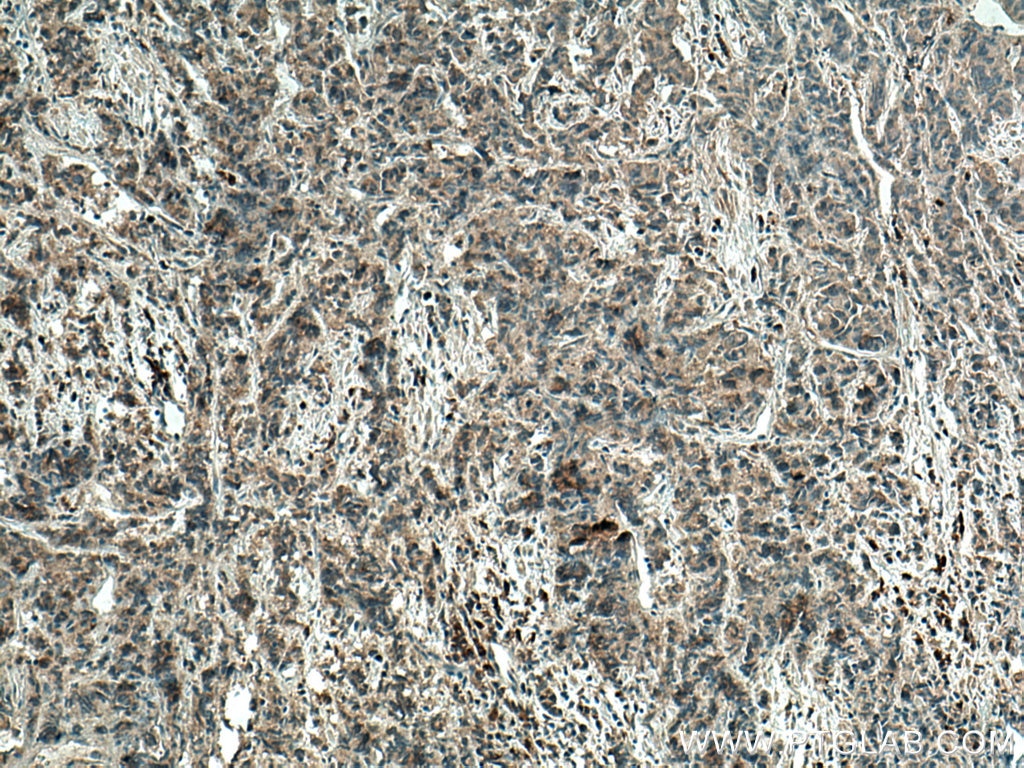 Immunohistochemistry (IHC) staining of human prostate cancer tissue using WFDC12 Polyclonal antibody (25101-1-AP)