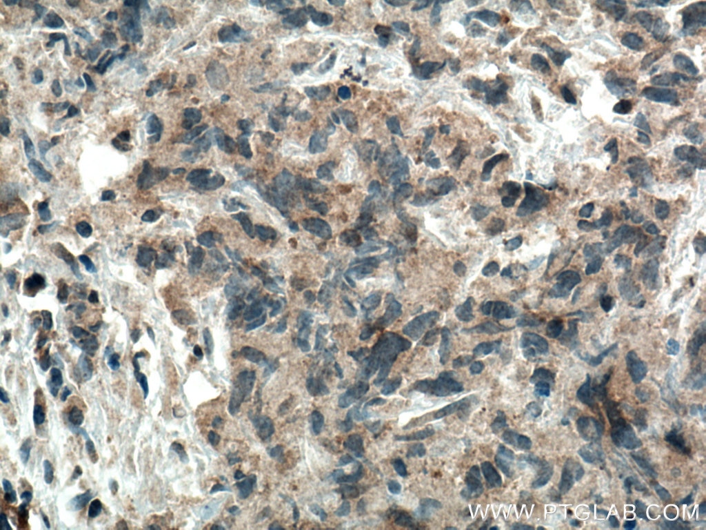 Immunohistochemistry (IHC) staining of human prostate cancer tissue using WFDC12 Polyclonal antibody (25101-1-AP)
