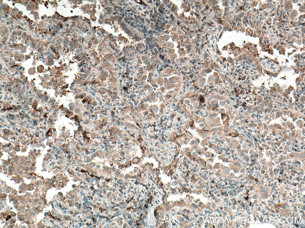 Immunohistochemistry (IHC) staining of human lung cancer tissue using WFDC12 Polyclonal antibody (25101-1-AP)