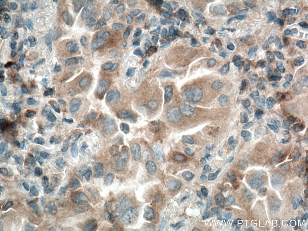Immunohistochemistry (IHC) staining of human lung cancer tissue using WFDC12 Polyclonal antibody (25101-1-AP)