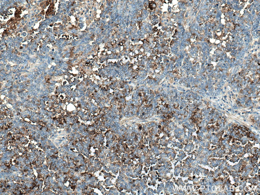 Immunohistochemistry (IHC) staining of human ovary tumor tissue using HE4 Polyclonal antibody (14406-1-AP)