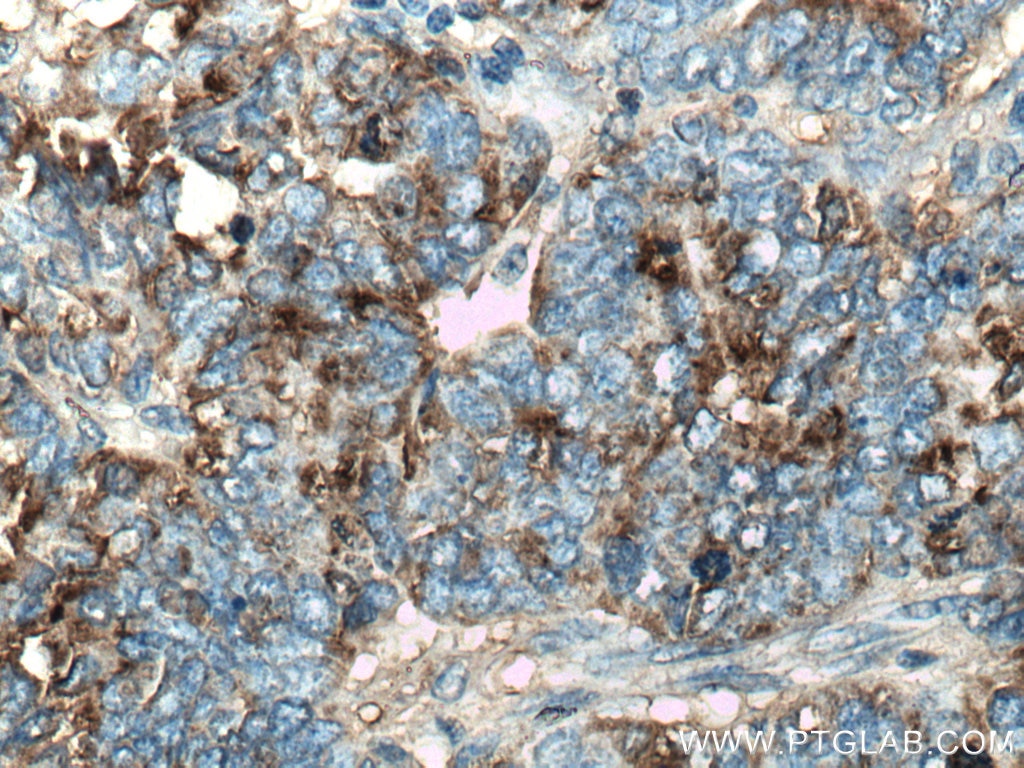 Immunohistochemistry (IHC) staining of human ovary tumor tissue using HE4 Polyclonal antibody (14406-1-AP)