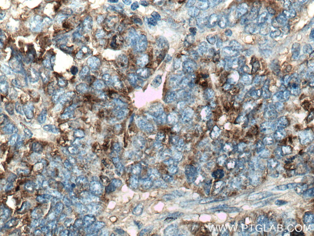 IHC staining of human ovary tumor using 14406-1-AP