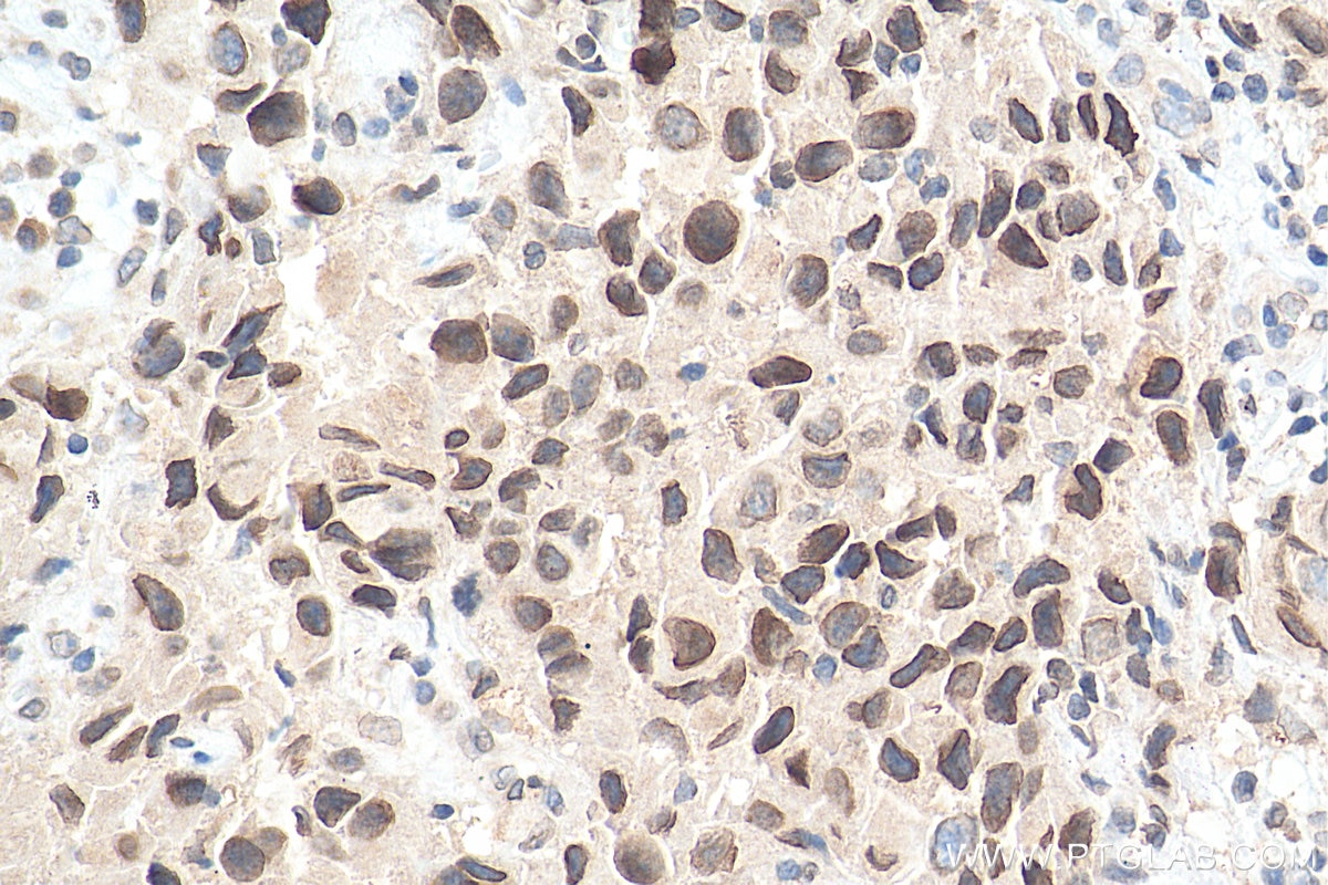 IHC staining of human breast cancer using 22722-1-AP