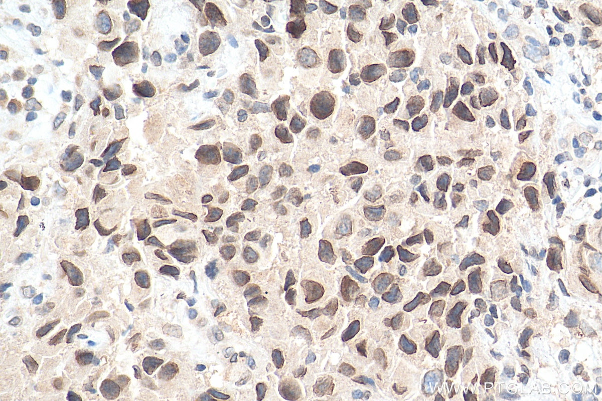 Immunohistochemistry (IHC) staining of human breast cancer tissue using WHSC1 Polyclonal antibody (22722-1-AP)