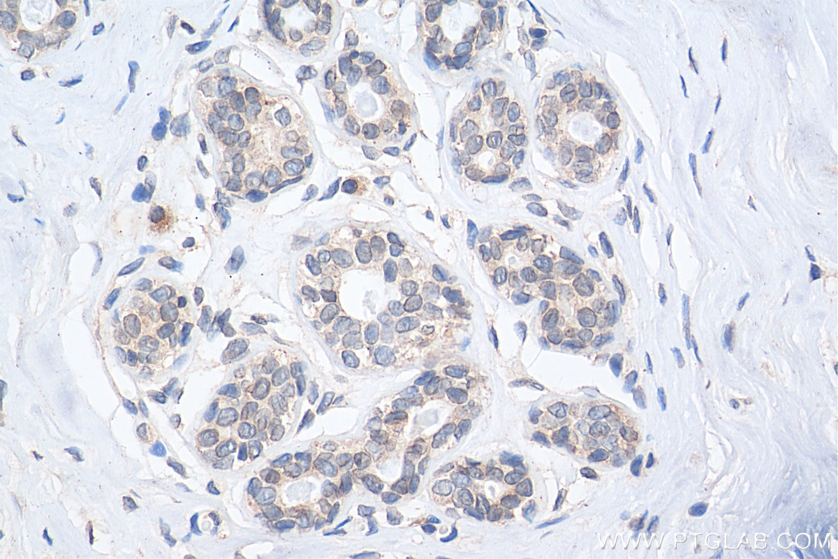 Immunohistochemistry (IHC) staining of human breast cancer tissue using WHSC1 Polyclonal antibody (22722-1-AP)