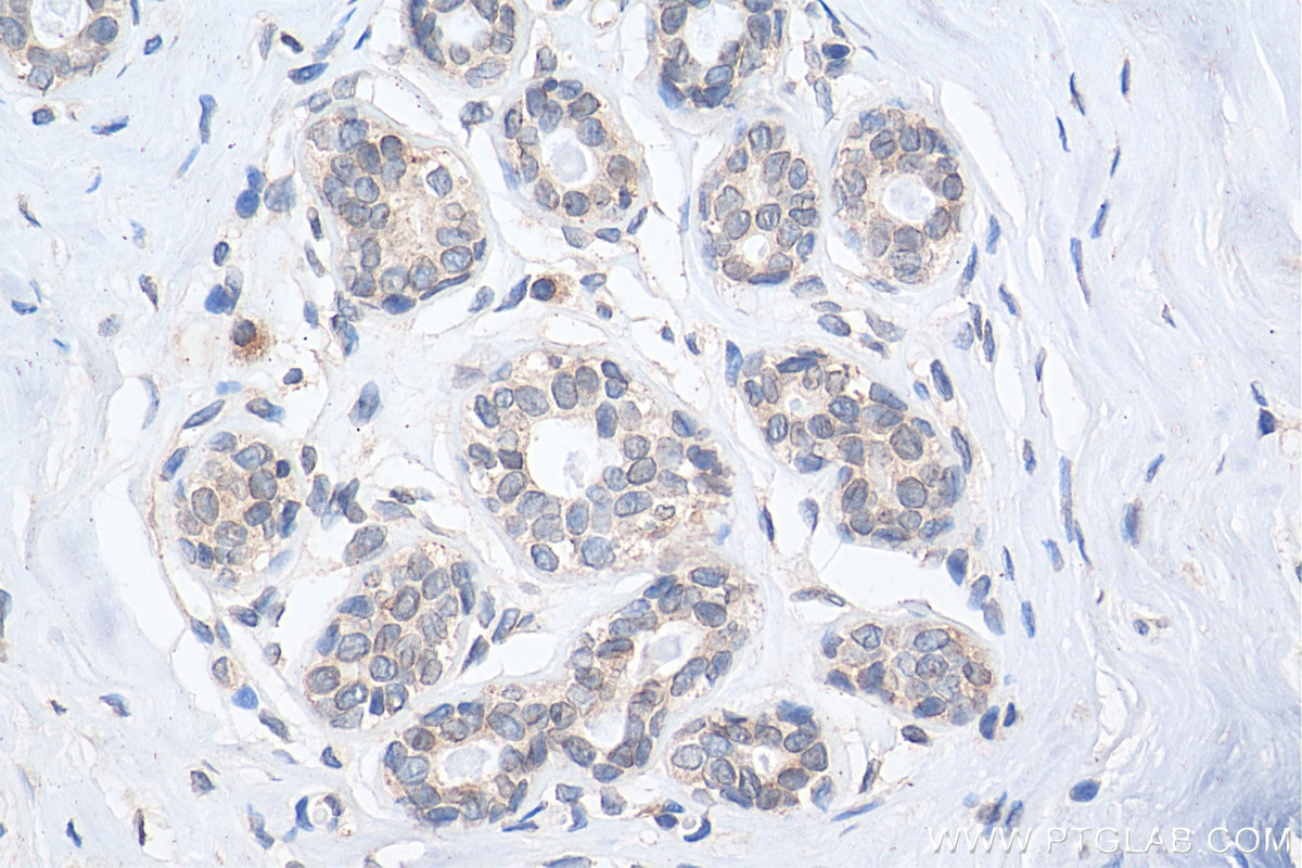 IHC staining of human breast cancer using 22722-1-AP