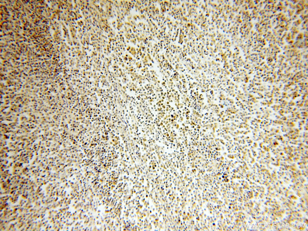 Immunohistochemistry (IHC) staining of human lymphoma tissue using NSD3 Polyclonal antibody (11345-1-AP)