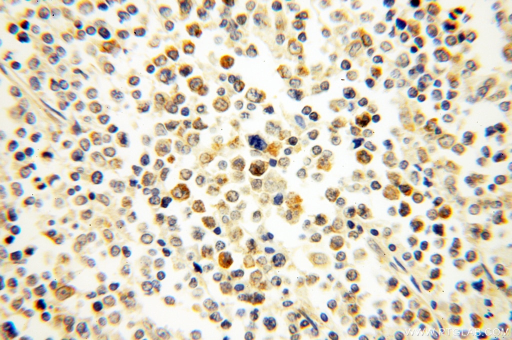Immunohistochemistry (IHC) staining of human lymphoma tissue using NSD3 Polyclonal antibody (11345-1-AP)