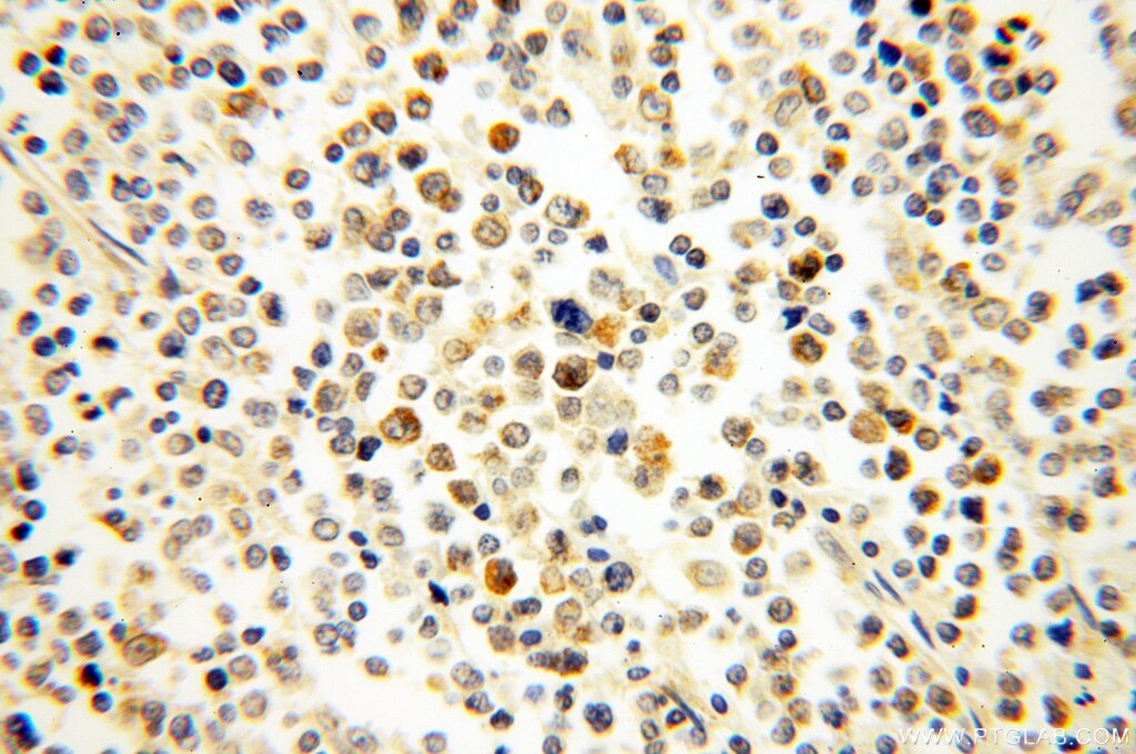 Immunohistochemistry (IHC) staining of human lymphoma tissue using NSD3 Polyclonal antibody (11345-1-AP)