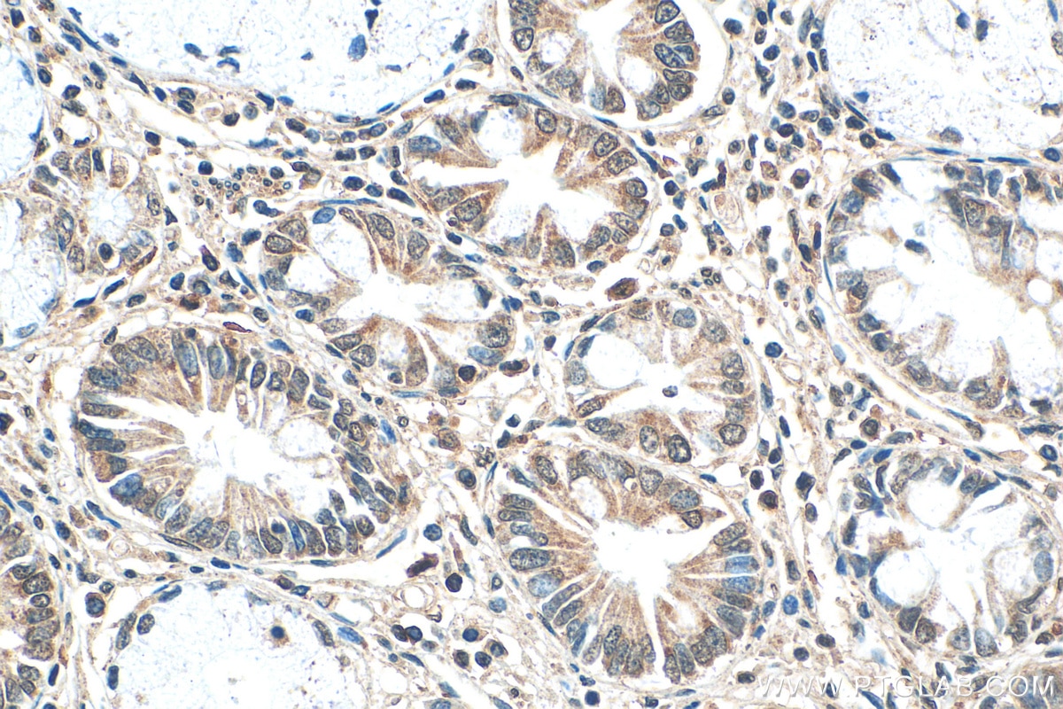 Immunohistochemistry (IHC) staining of human stomach cancer tissue using WIPF1 Polyclonal antibody (22047-1-AP)