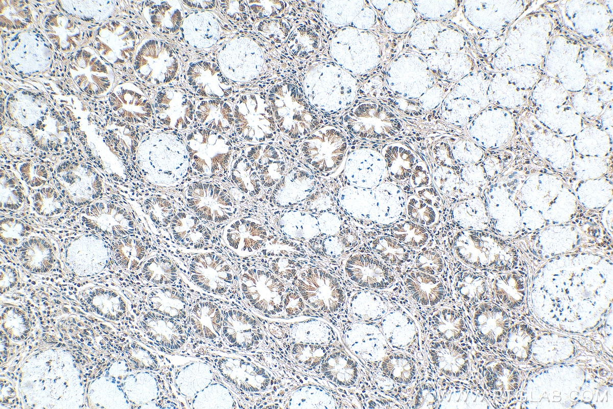 IHC staining of human stomach cancer using 22047-1-AP