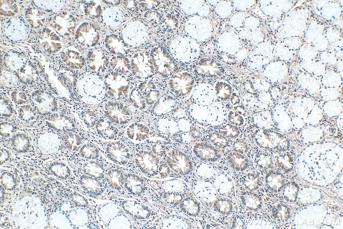 Immunohistochemistry (IHC) staining of human stomach cancer tissue using WIPF1 Polyclonal antibody (22047-1-AP)