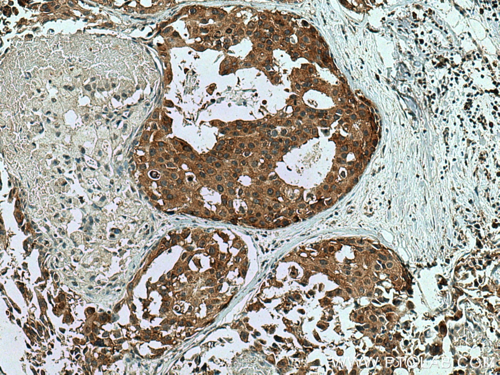 Immunohistochemistry (IHC) staining of human breast cancer tissue using WIPF2 Polyclonal antibody (20512-1-AP)