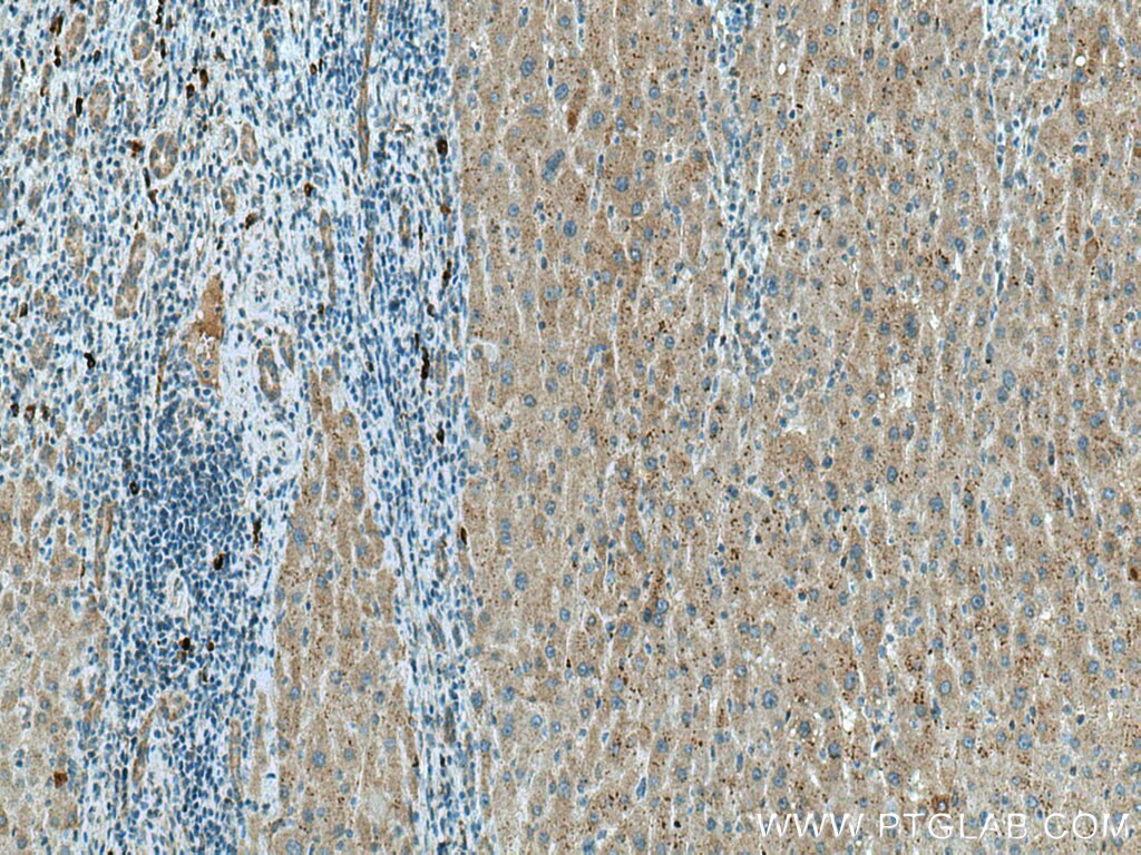 Immunohistochemistry (IHC) staining of human liver cancer tissue using WIPF2 Polyclonal antibody (20512-1-AP)