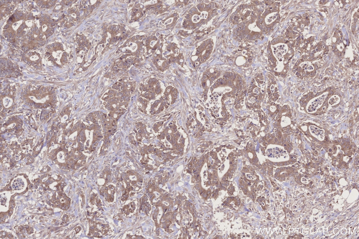 Immunohistochemistry (IHC) staining of human rectal cancer tissue using WIPF2 Polyclonal antibody (20512-1-AP)