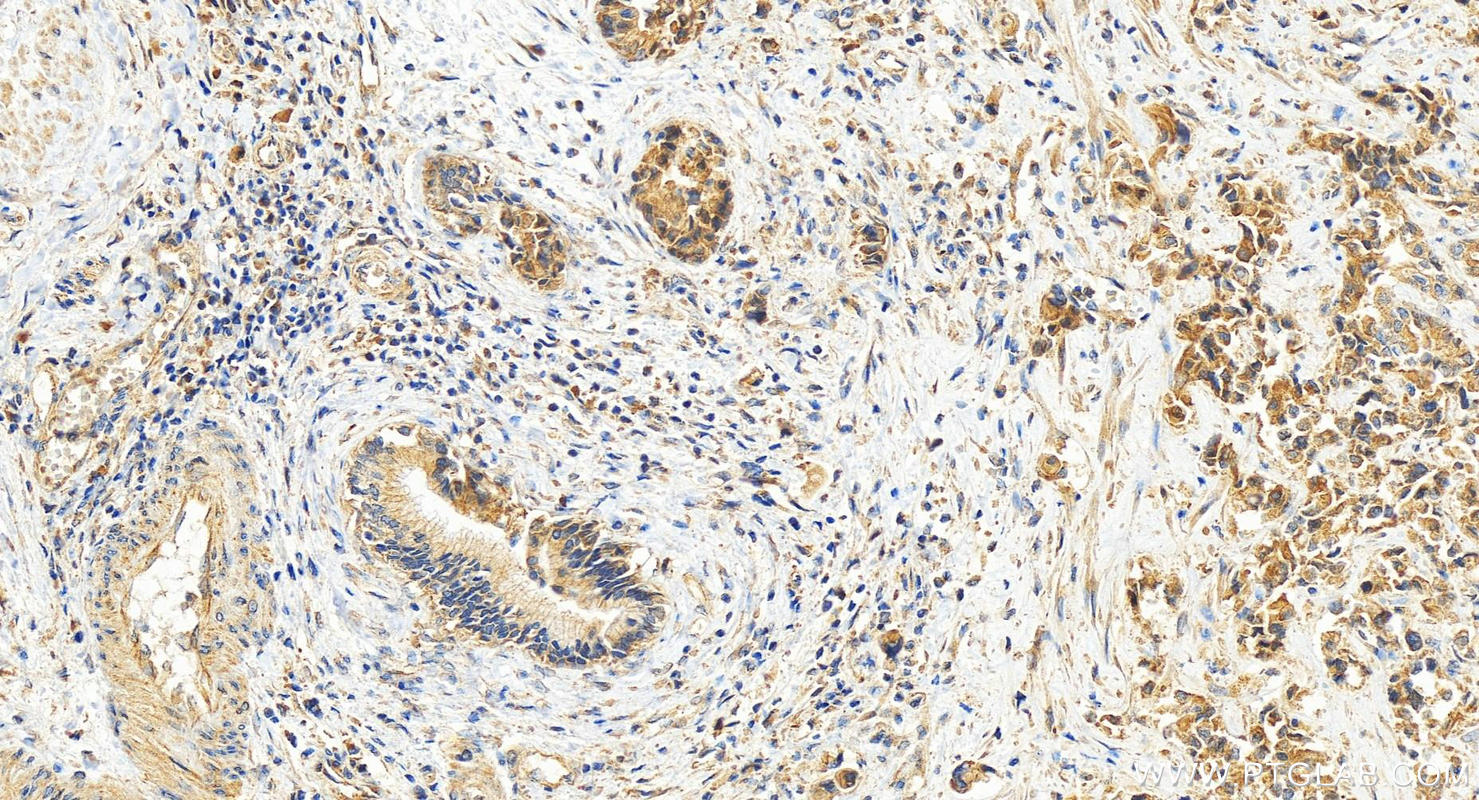 Immunohistochemistry (IHC) staining of human intrahepatic cholangiocarcinoma tissue using WIPI1 Polyclonal antibody (25204-1-AP)