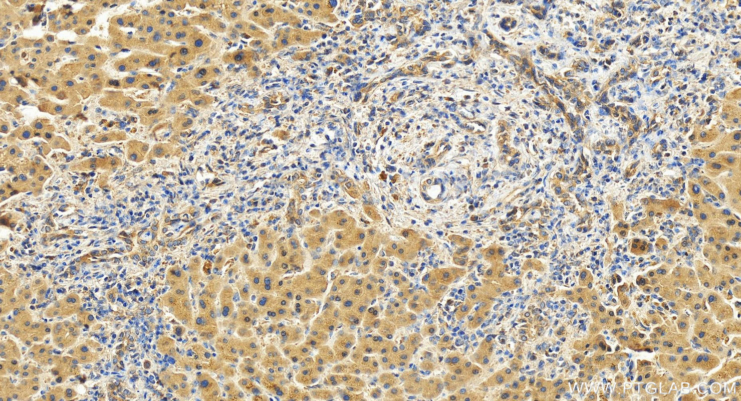 Immunohistochemistry (IHC) staining of human intrahepatic cholangiocarcinoma tissue using WIPI1 Polyclonal antibody (25204-1-AP)