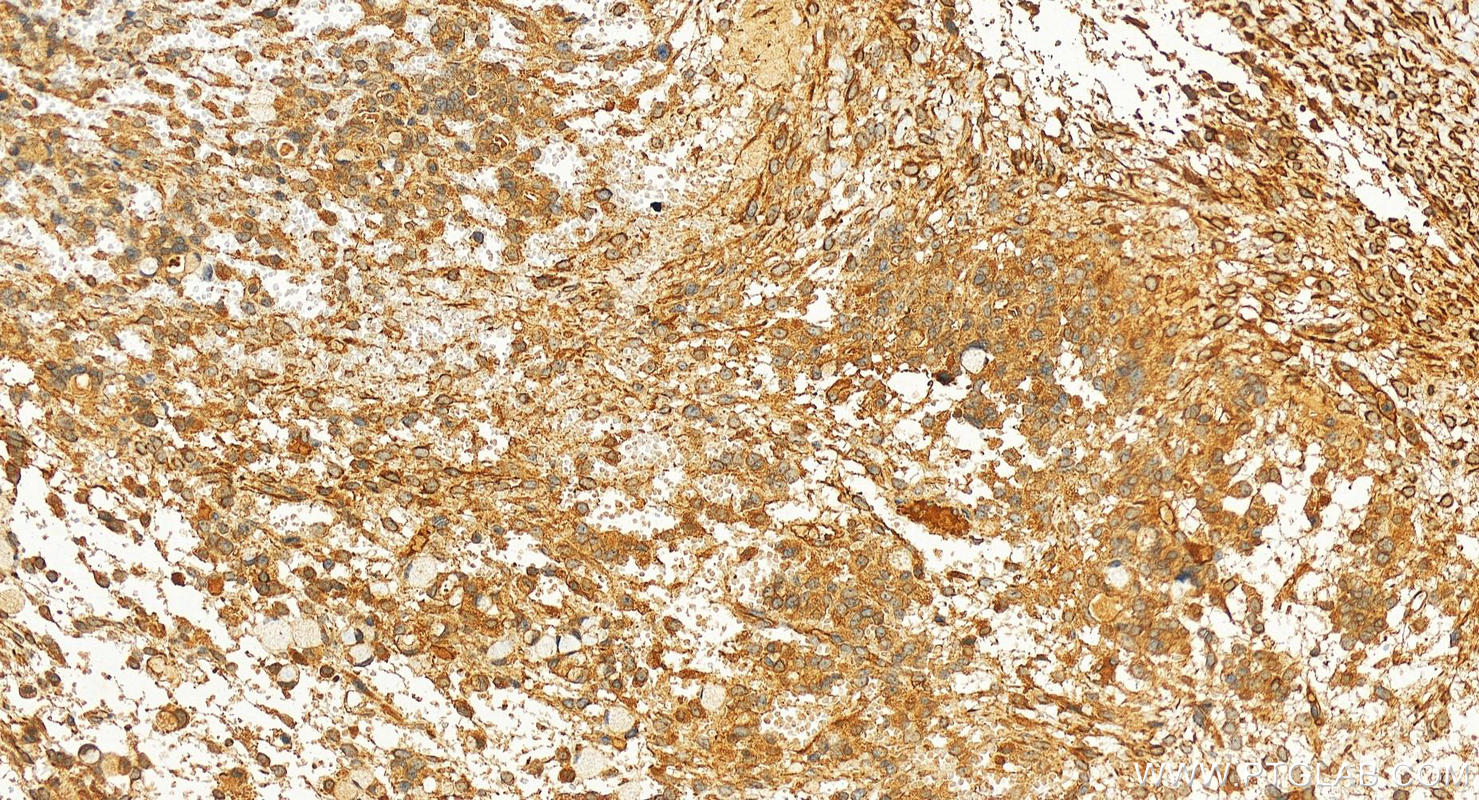 Immunohistochemistry (IHC) staining of human ovary cancer tissue using WIPI1 Polyclonal antibody (25204-1-AP)