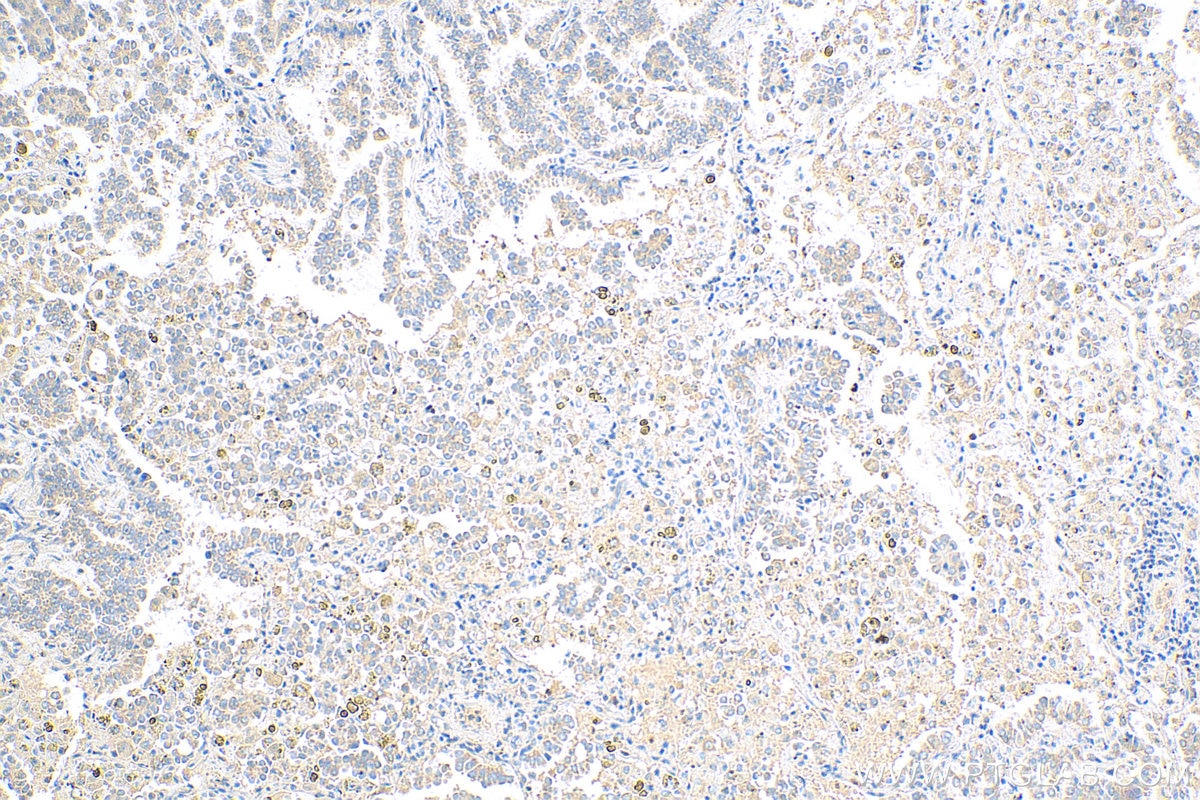 Immunohistochemistry (IHC) staining of human lung cancer tissue using WISP1 Polyclonal antibody (18166-1-AP)