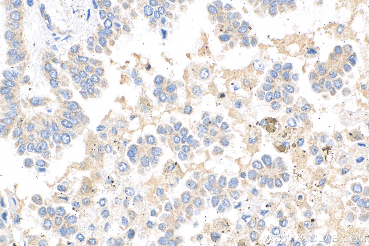 Immunohistochemistry (IHC) staining of human lung cancer tissue using WISP1 Polyclonal antibody (18166-1-AP)