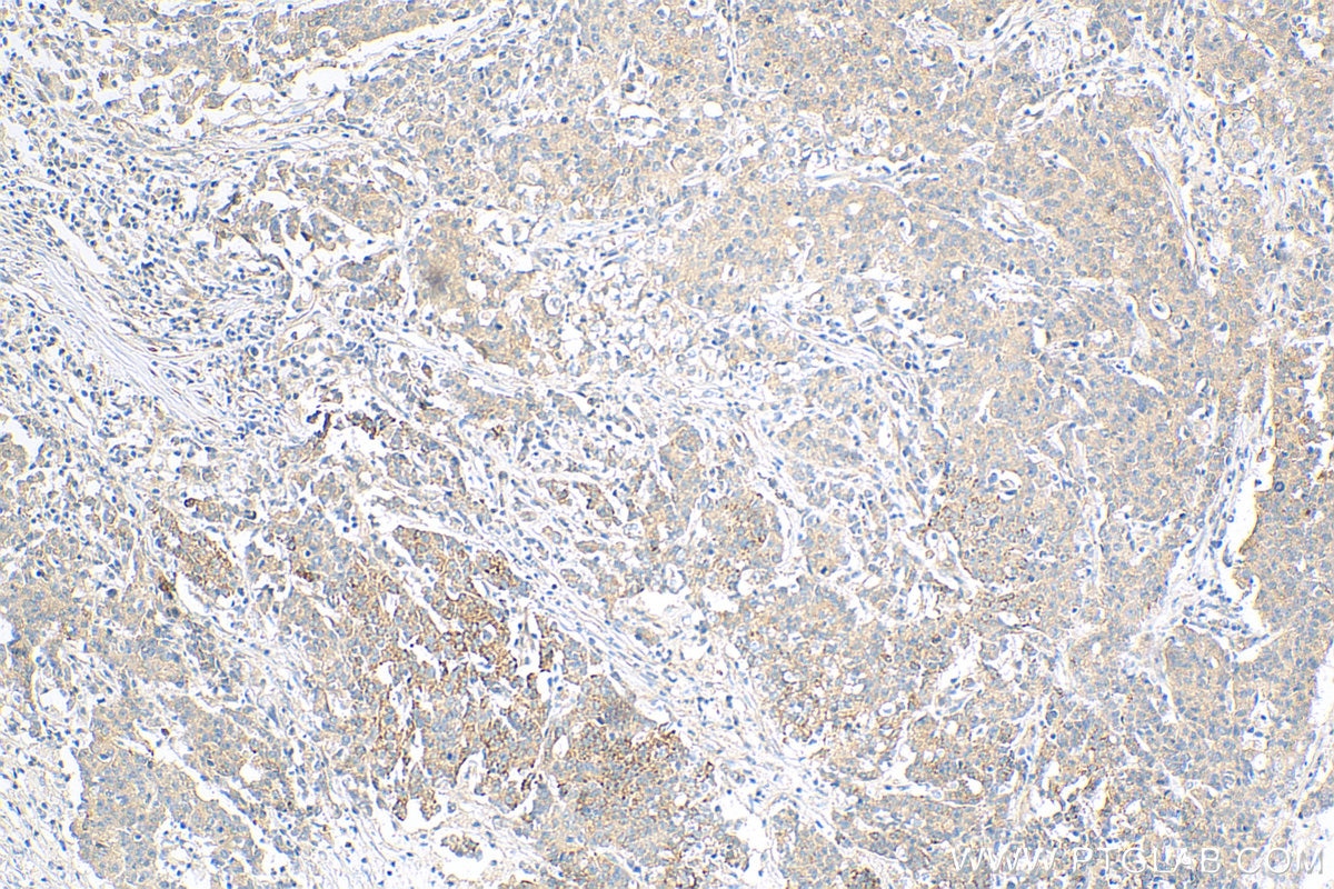 Immunohistochemistry (IHC) staining of human stomach cancer tissue using WISP1 Polyclonal antibody (18166-1-AP)