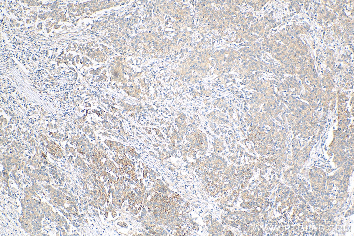 IHC staining of human stomach cancer using 18166-1-AP