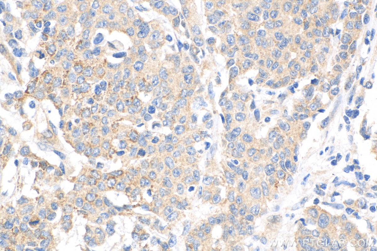 Immunohistochemistry (IHC) staining of human stomach cancer tissue using WISP1 Polyclonal antibody (18166-1-AP)