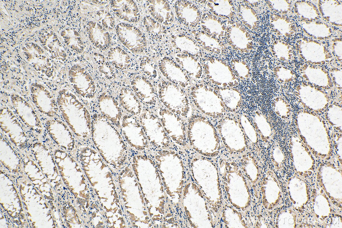 Immunohistochemistry (IHC) staining of human colon cancer tissue using WISP3 Polyclonal antibody (21259-1-AP)