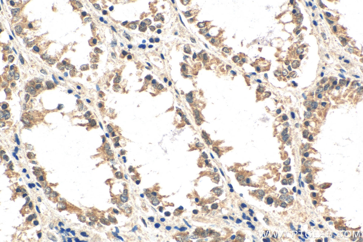 Immunohistochemistry (IHC) staining of human colon cancer tissue using WISP3 Polyclonal antibody (21259-1-AP)