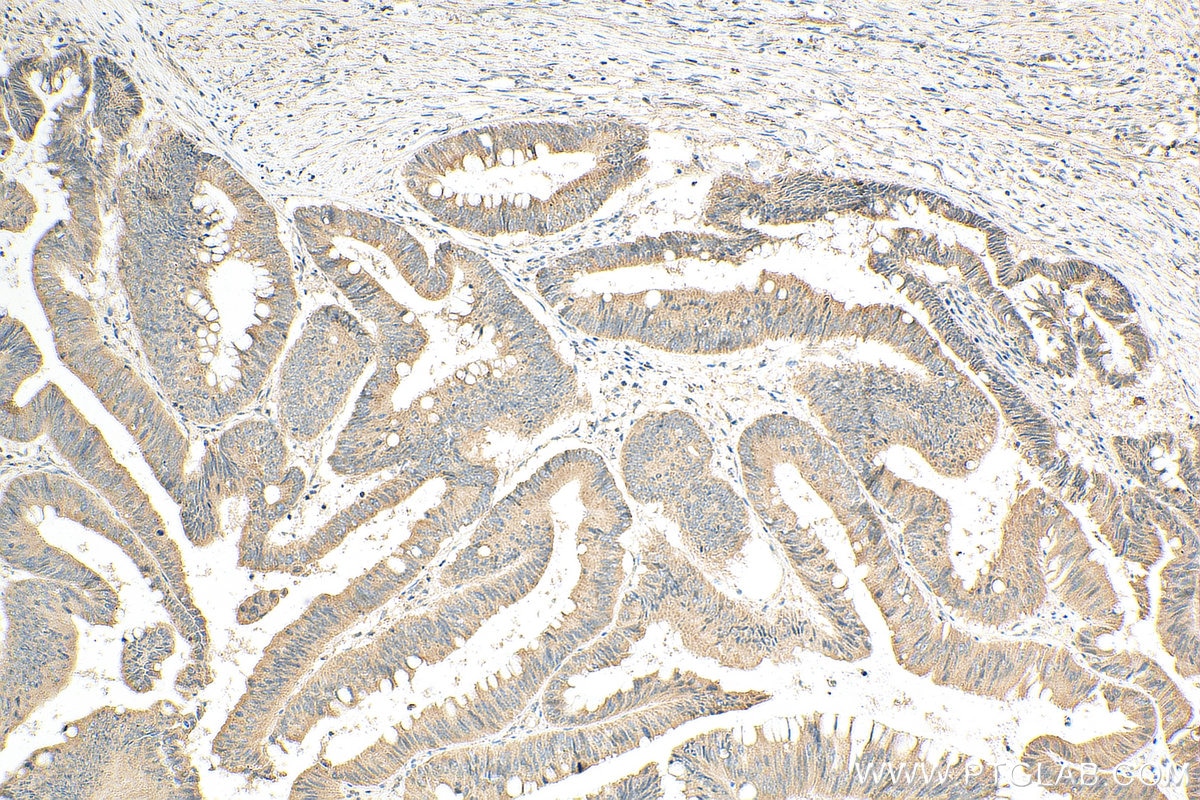 Immunohistochemistry (IHC) staining of human colon cancer tissue using WISP3 Polyclonal antibody (21259-1-AP)