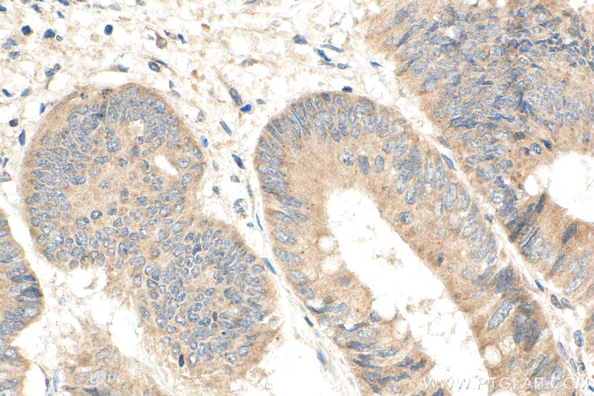 Immunohistochemistry (IHC) staining of human colon cancer tissue using WISP3 Polyclonal antibody (21259-1-AP)