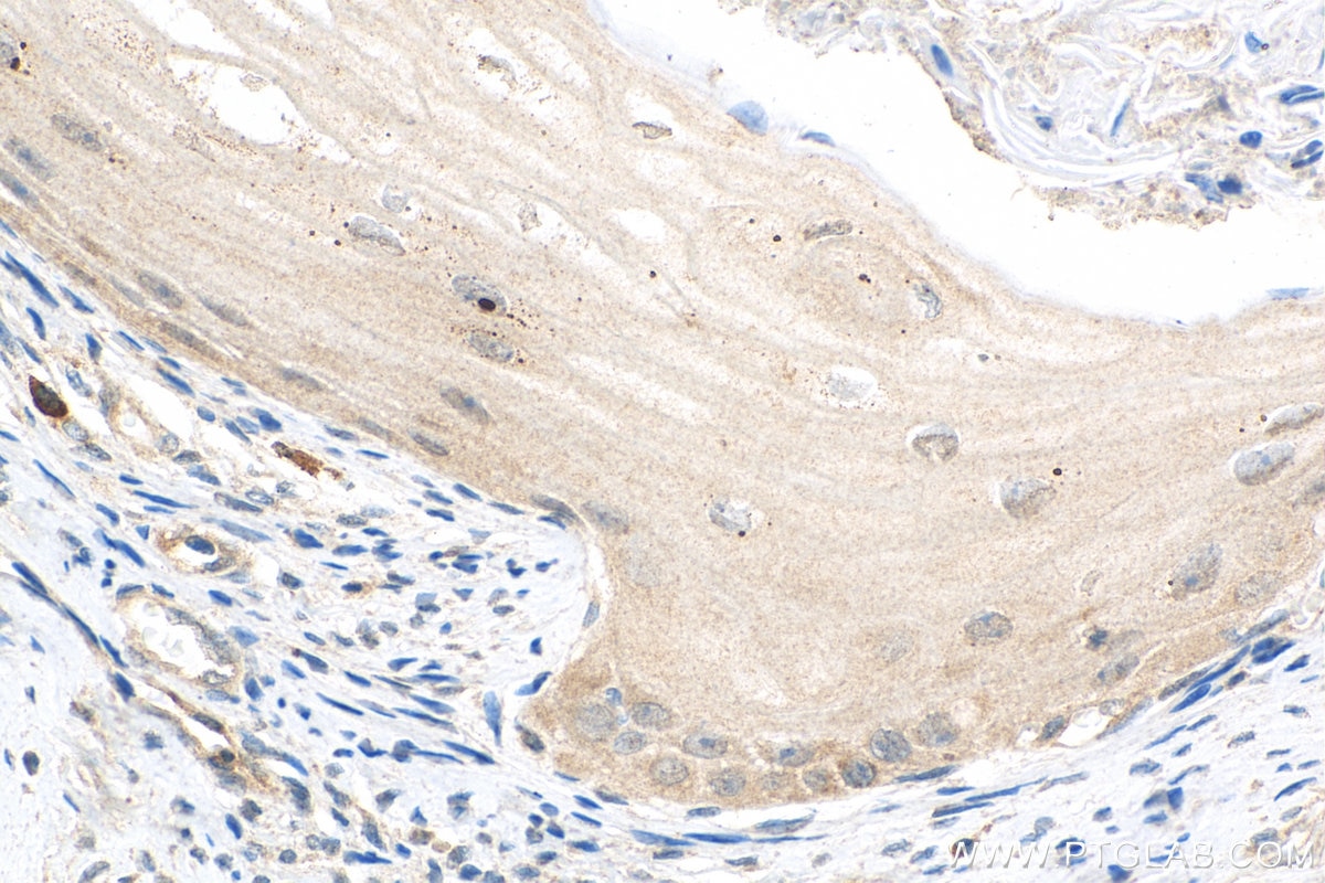 Immunohistochemistry (IHC) staining of human ovary tumor tissue using WIT1 Polyclonal antibody (15458-1-AP)