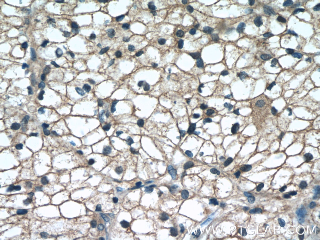 Immunohistochemistry (IHC) staining of human nephroblastoma tissue using WIT1 Polyclonal antibody (15458-1-AP)
