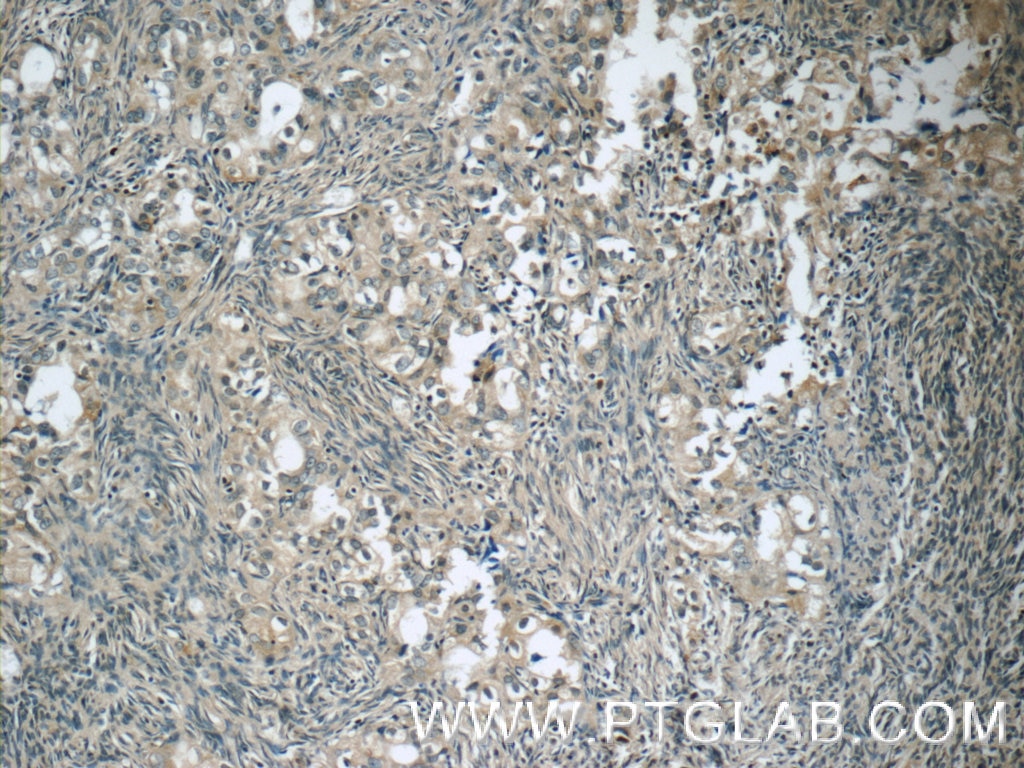 Immunohistochemistry (IHC) staining of human ovary tumor tissue using WIT1 Polyclonal antibody (15458-1-AP)