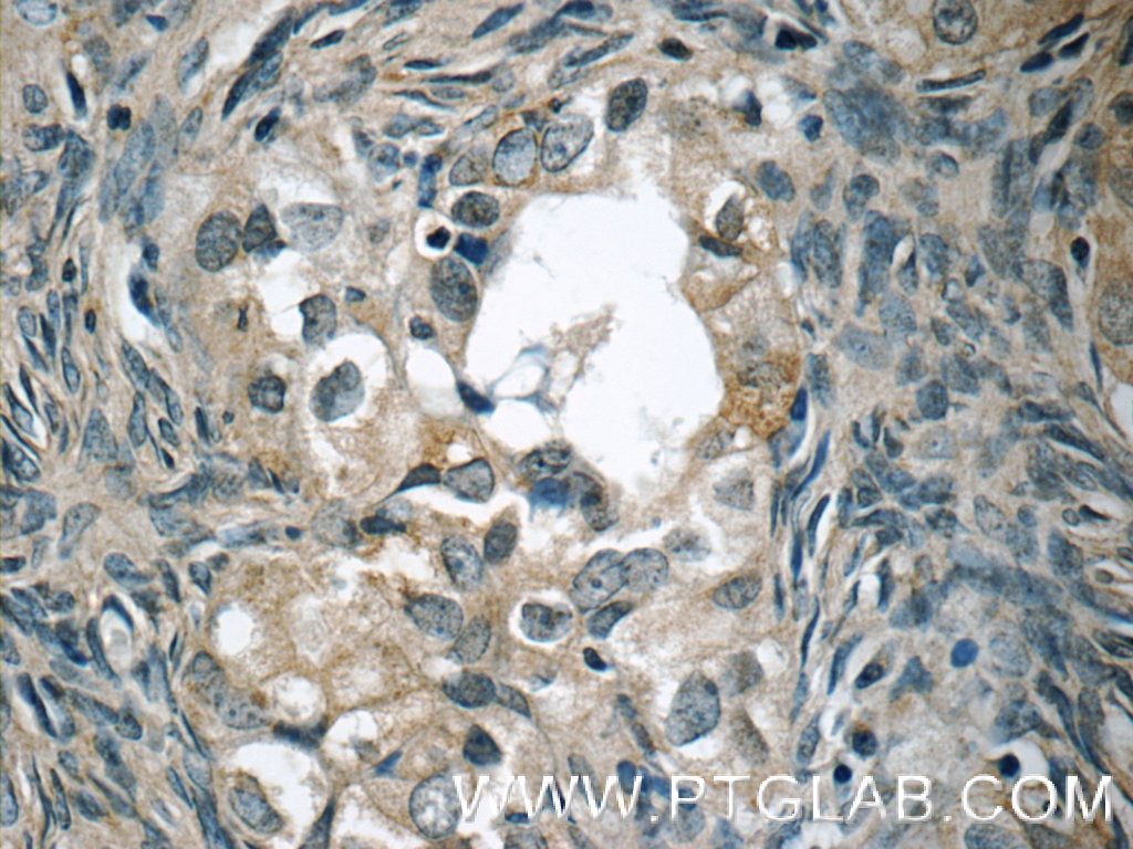 Immunohistochemistry (IHC) staining of human ovary tumor tissue using WIT1 Polyclonal antibody (15458-1-AP)