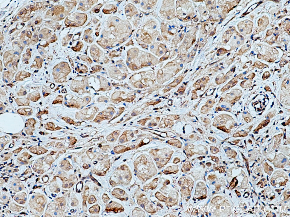 Immunohistochemistry (IHC) staining of human breast cancer tissue using WNK1 Polyclonal antibody (28357-1-AP)