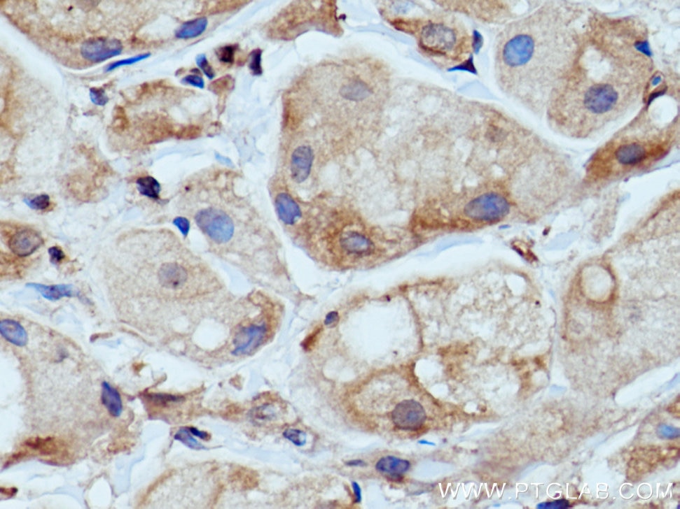 Immunohistochemistry (IHC) staining of human breast cancer tissue using WNK1 Polyclonal antibody (28357-1-AP)