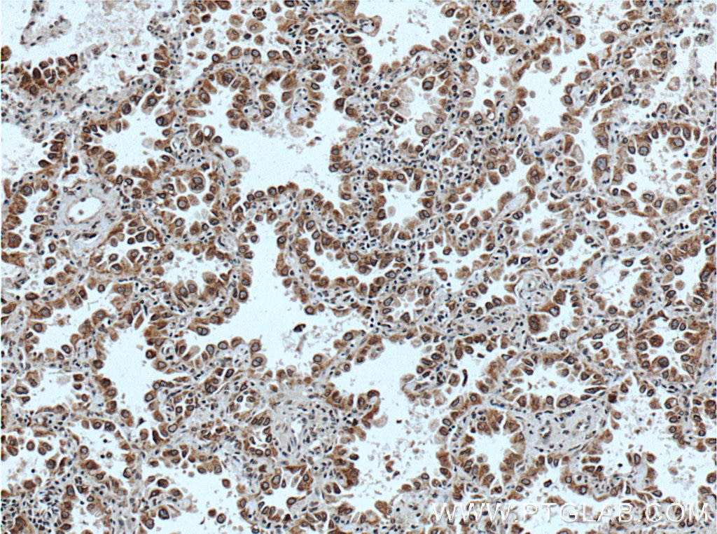 Immunohistochemistry (IHC) staining of human lung cancer tissue using WNK2 Polyclonal antibody (22297-1-AP)