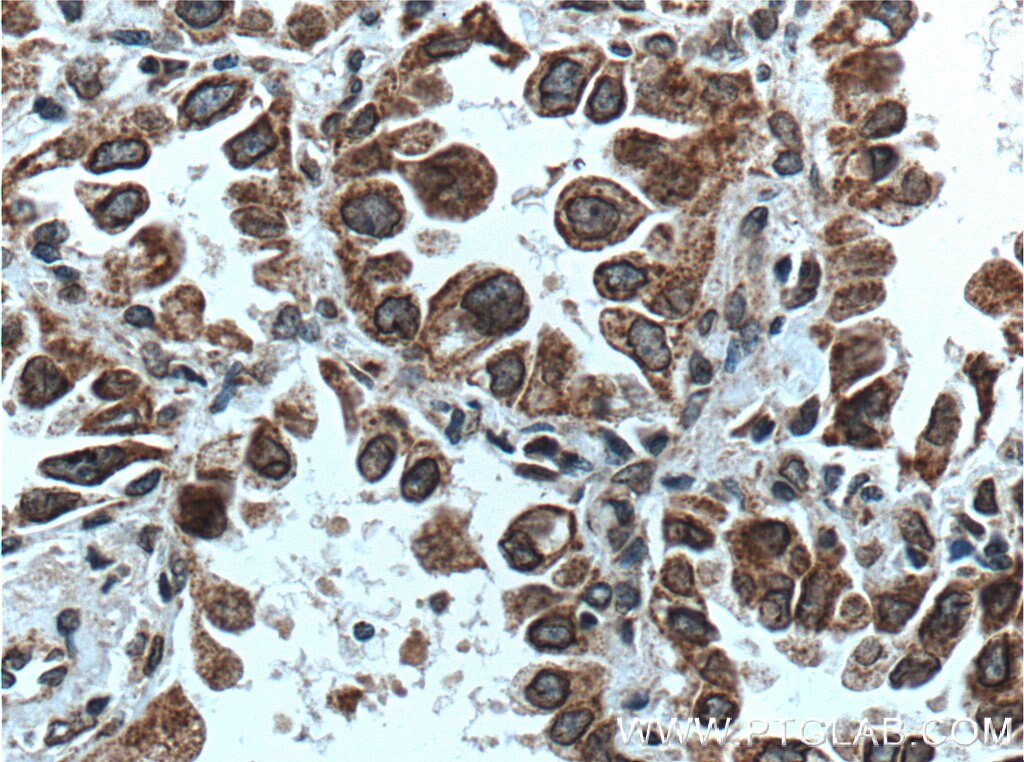 Immunohistochemistry (IHC) staining of human lung cancer tissue using WNK2 Polyclonal antibody (22297-1-AP)