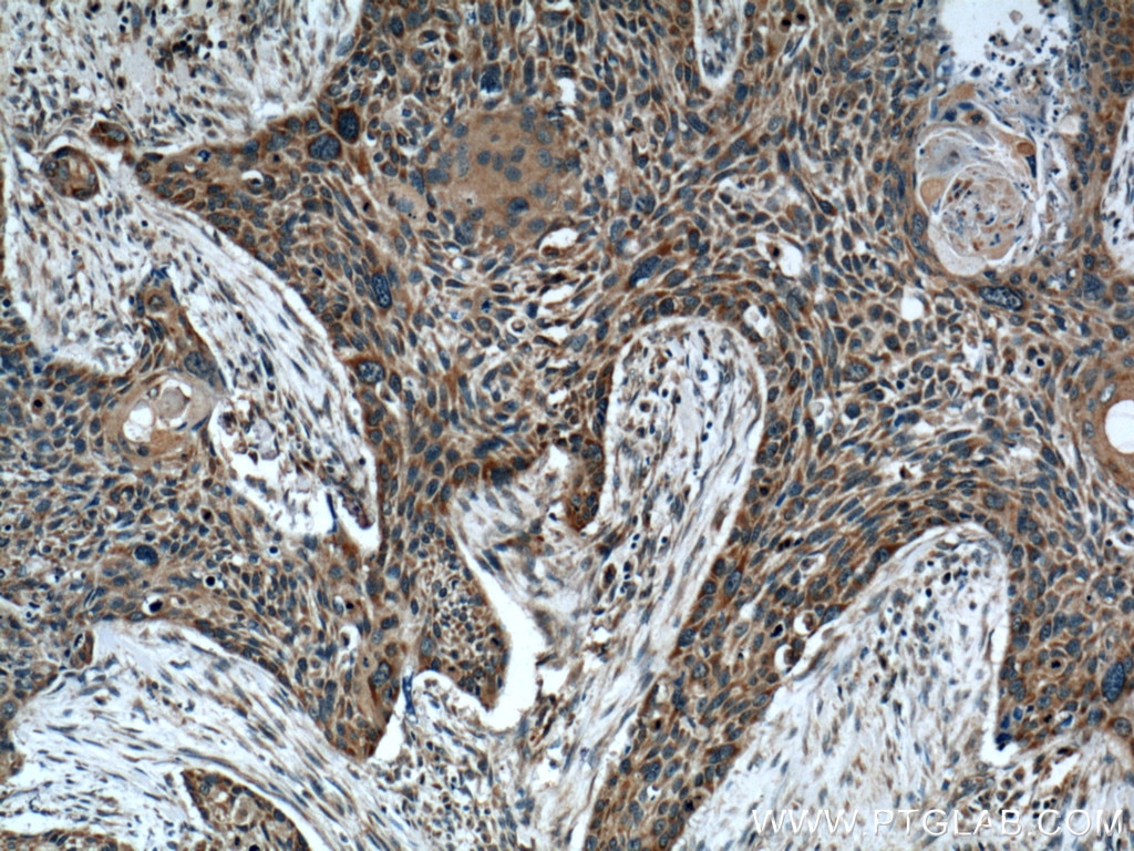 Immunohistochemistry (IHC) staining of human oesophagus cancer tissue using WNT10A Polyclonal antibody (26238-1-AP)