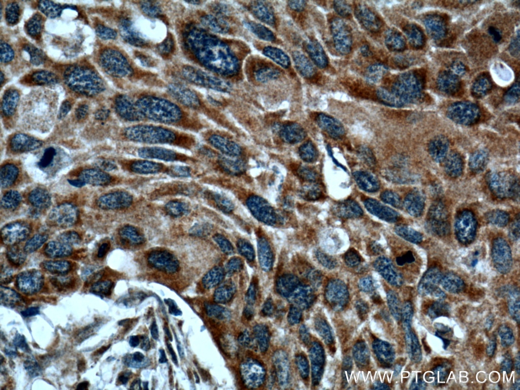 Immunohistochemistry (IHC) staining of human oesophagus cancer tissue using WNT10A Polyclonal antibody (26238-1-AP)