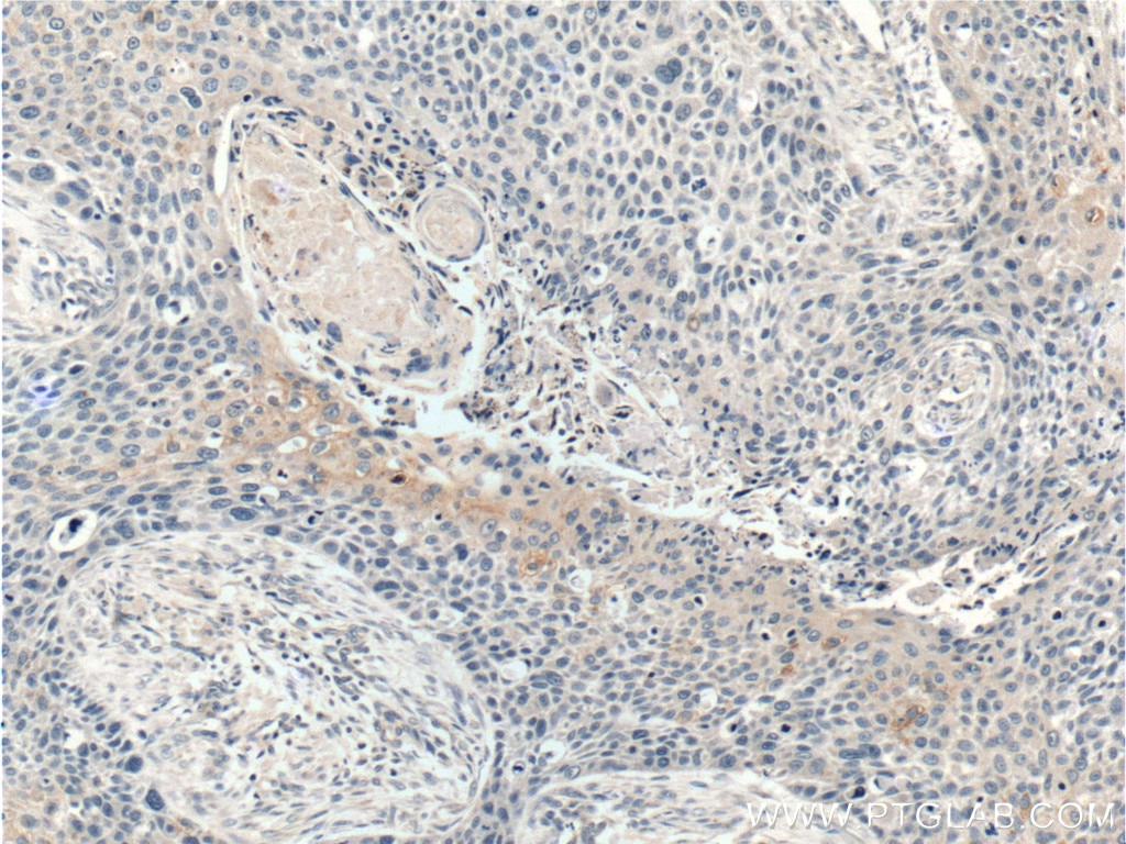 Immunohistochemistry (IHC) staining of human oesophagus cancer tissue using WNT10A Polyclonal antibody (26238-1-AP)