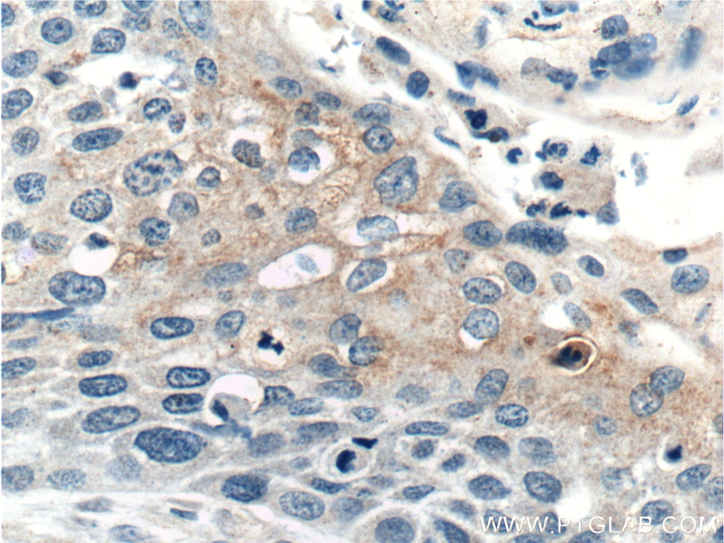 Immunohistochemistry (IHC) staining of human oesophagus cancer tissue using WNT10A Polyclonal antibody (26238-1-AP)