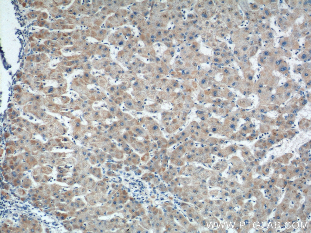Immunohistochemistry (IHC) staining of human hepatocirrhosis tissue using WNT4 Polyclonal antibody (14371-1-AP)
